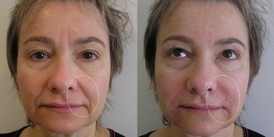 Middle-aged woman with poor filler results