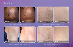 Before and after pics showing laser hair removal