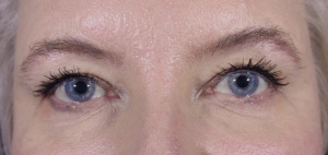 After: Tightened eyelids