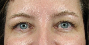 Before: heavy eyelids