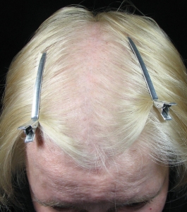 Scalp before microneedling treatments showing extensive hair loss