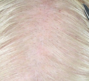 Closer view of scalp before MN treatment