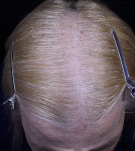 Scalp after 1st MN treatment