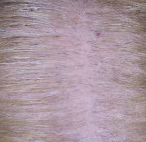 Close up of scalp after 1st microneedling treatment