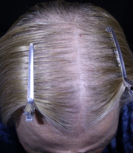 Scalp after 5 MN treatments showing improved hair growth