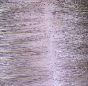 Close up of scalp after 5 microneedling treatments