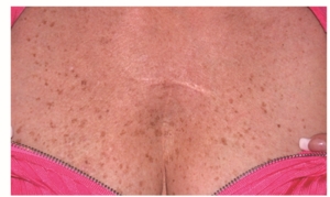 Freckly reddened rough chest skin before treatments