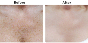 Sun damage before and after treatment