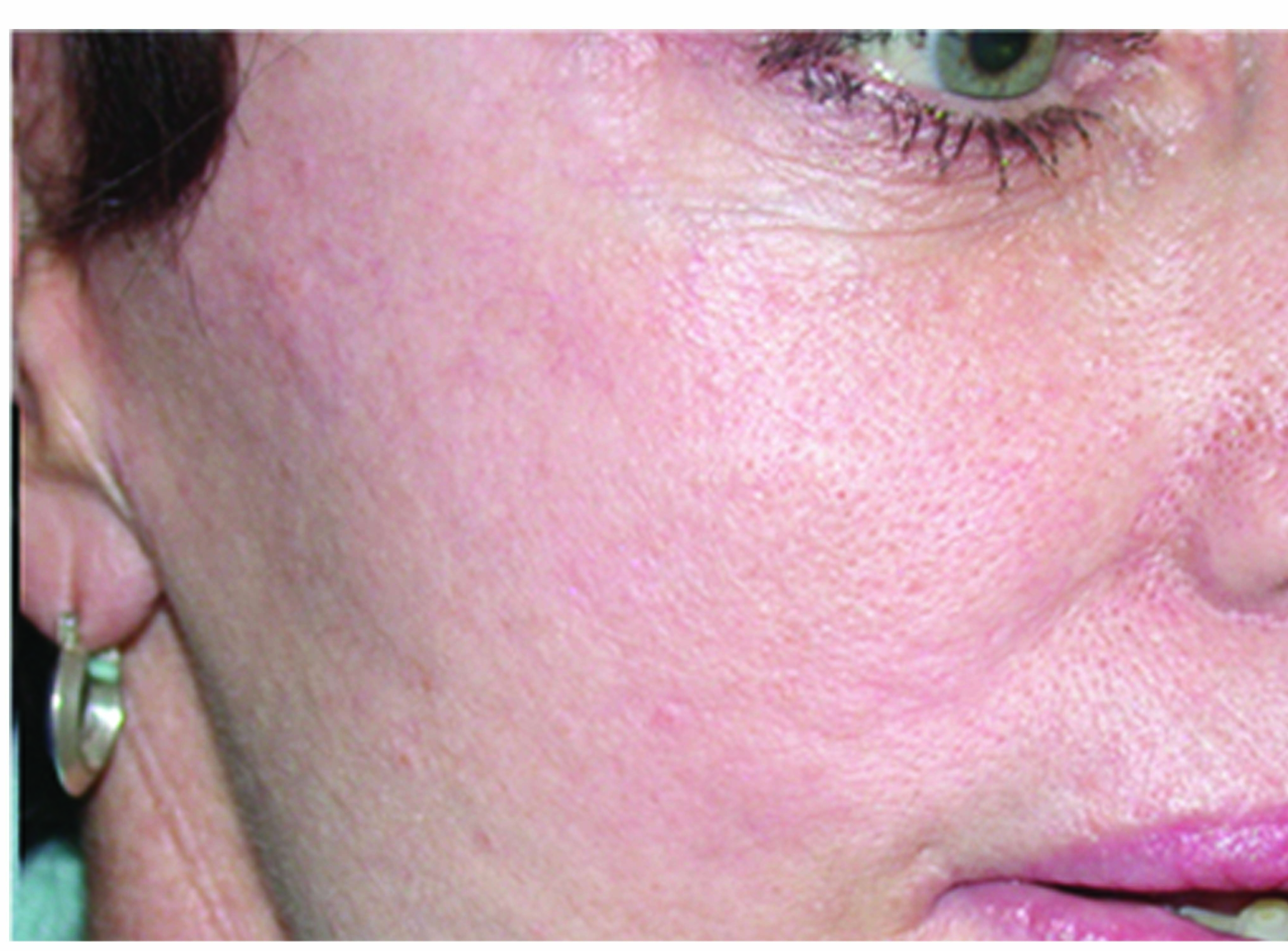 After Photofacials showing bright radiant skin with much reduced redness and brown spots erased