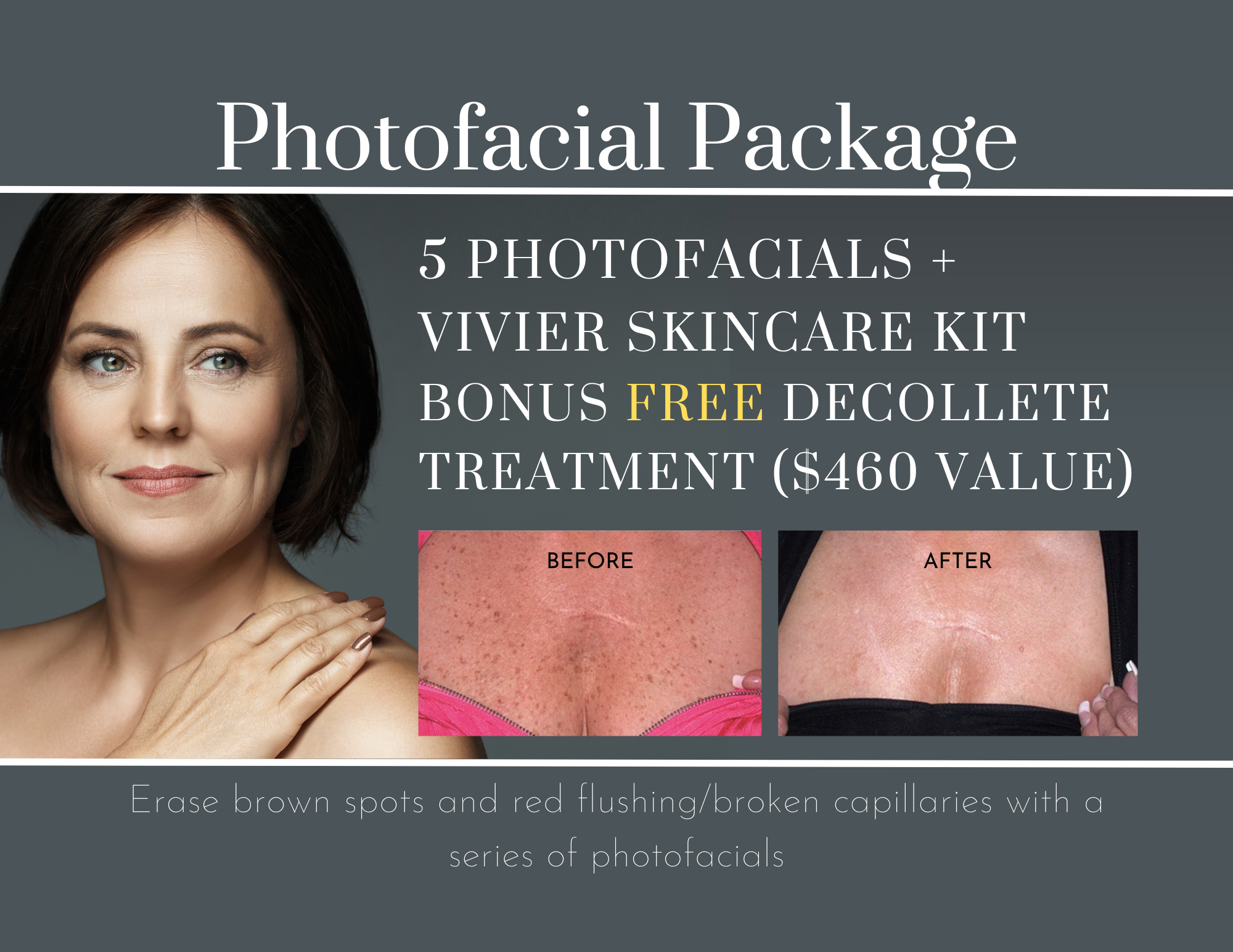 Photofacial Package; 5 photofacials plus vivier skin care kit, bonus free delcollete treatment ($460 vakye)