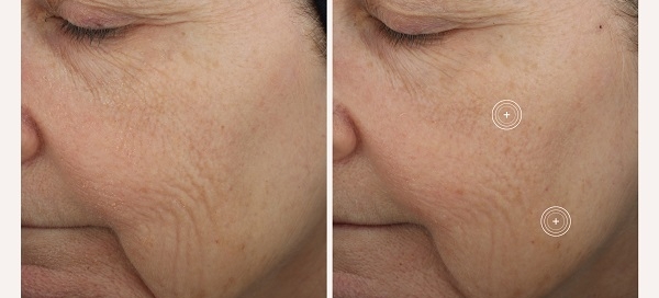 Before and after pics of TNS Advanced+ Serum user showing reduction in wrinkles around eyes and on cheeks