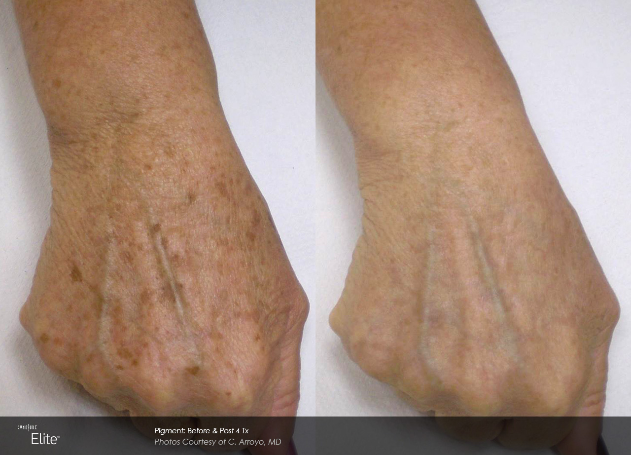Before and after photos of hand showing effects of laser treatment clearing brown sun spots