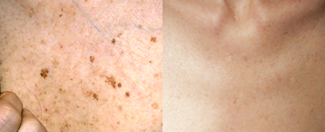 Before and after photos of chest decollete laser treatment showing clearing of brown sun spots