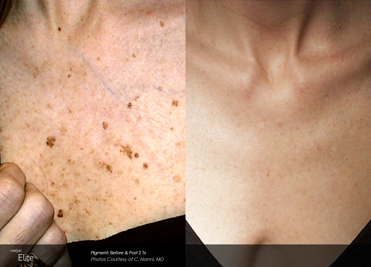 Before and after photos of chest decollete laser treatment showing clearing of brown sun spots