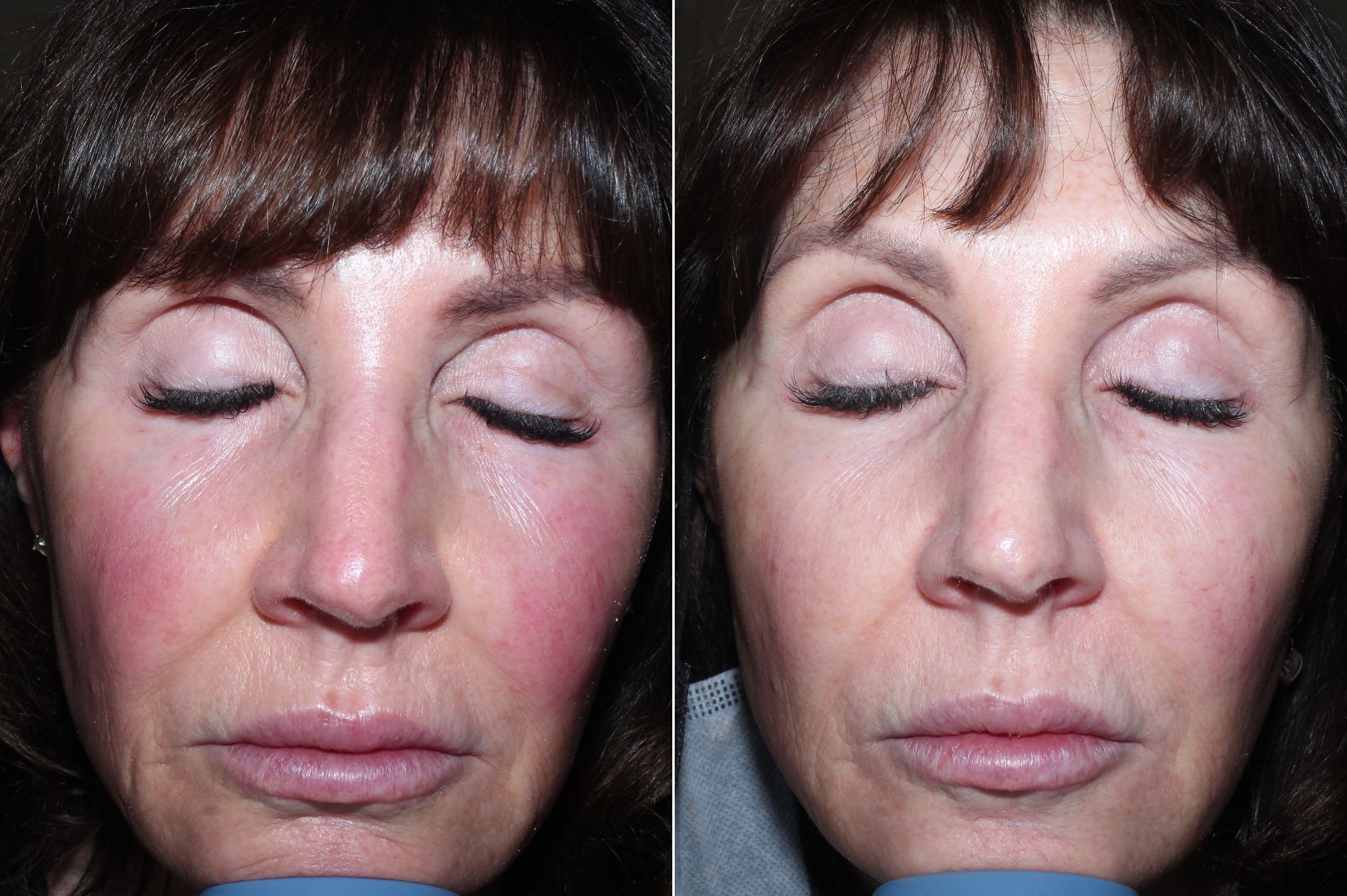 Before and after photos of woman who used exosomes to reduce redness and rejuvenate her skin