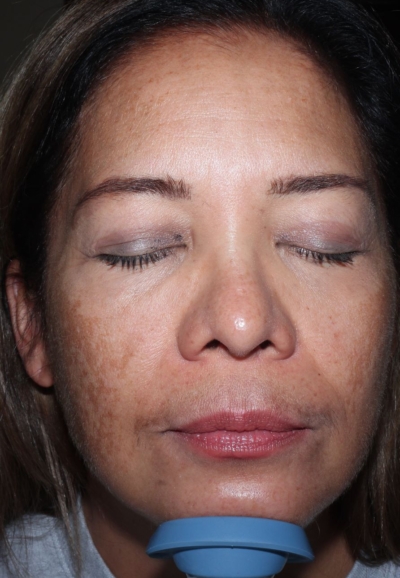 57 yr old woman before using exosomes, showing extensive hyperpigmentation