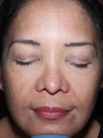 After using exosomes, showing brighter, more radiant skin and a significant reduction in hyperpigmentation