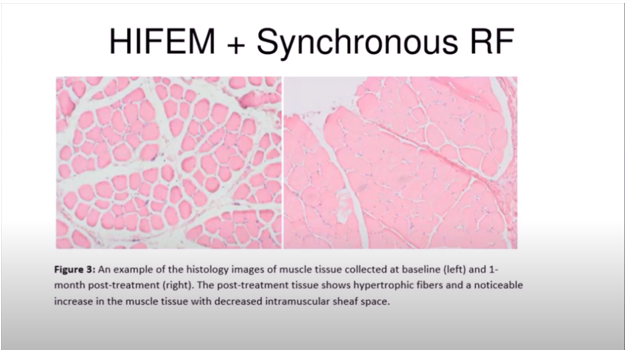 Micrographs of muscle bundles in cross-section. Left, untreated. Right, treated with HIFEM and radiofrequency