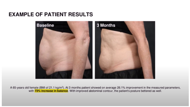 Before and after images of 65 yr old woman treated with Emsculpt Neo and pelvic floor HIFEM