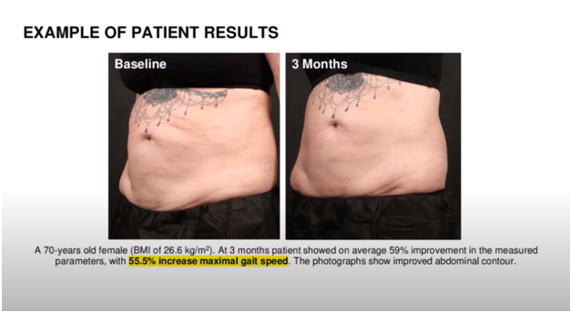 Before and after pictures of 70 yr old woman treated with Emsculpt Neo and pelvic floor HIFEM