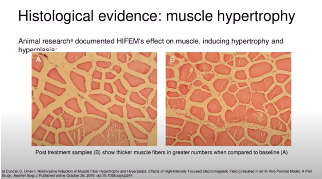 Micrographs of muscle bundles in cross-section. Left, untreated. Right, treated with HIFEM alone