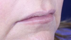 Jennifer's lips in semi profile after Hart Lip technique