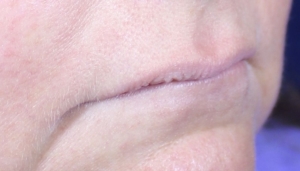 Jennifer's lips semi profile before Hart Lip