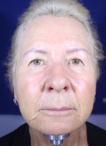 Full face view of Sandy before Hart Lip technique