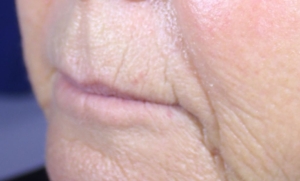 Profile view of Sandy's lips before augmentation