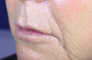 Sandy's profile after lip augmentation with the Hart Lip technique.