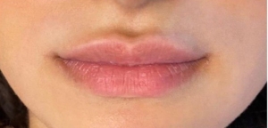 Lips with filler outside of upper lip margin