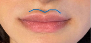 Lips with blue line marking where filler has leaked beyond lip margin