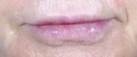 Bev's lips after Hart Lip technique