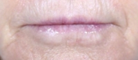 Frontal view of Bev's lips before filler