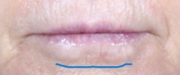 Bev's lips before filler. Blue line marks bulge under lower lip