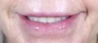 Bev's smile, from the front, after filler