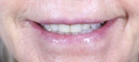 Bev's smile, from the front, before filler