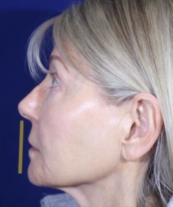 Model's profile showing flattening of line from nose to chin