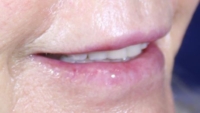 Bev's smile after filler