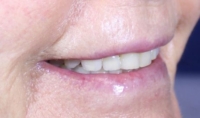 Bev's smile before filler