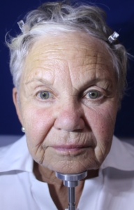 Linda Before, showing deep wrinkles, red cheeks and nose