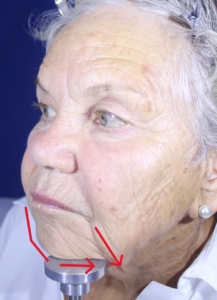 Linda Before. Red lines indicate the receding chin and the deep sagging of the jowl.