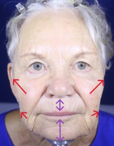 Linda After. Arrows indicate the lifting of cheeks by filler