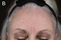 Older woman's forehead after using serum showing reduction in wrinkles and sun damage