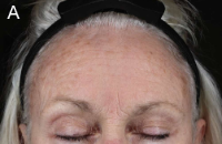 Older woman's forehead before treatment with exosomes