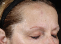 Older woman after using serum for 6 weeks showing reduction in wrinkles at corner of eye