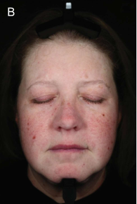 48 year old woman after using serum for 6 weeks showing marked reduction in redness