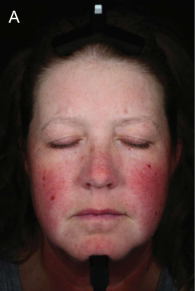 Face of 48 year old woman before using serum showing extensive redness on cheeks and nose